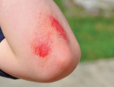 Αυτά είναι τα καλύτερα γιατροσόφια για πληγές και κοψίματα